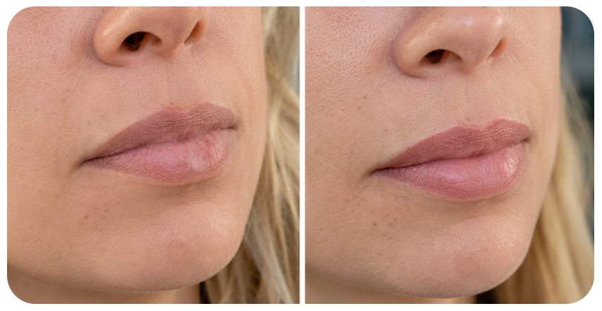 Resultado real de pigmentacao labial cor contorno naturalidade com avaliação individual